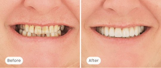 A before-and-after photo showing a Mulgrave Dental Group patient's veneer smile makeover. The 'before' image shows discoloured, uneven, and worn teeth. The 'after' image shows straight, white, and evenly shaped teeth.