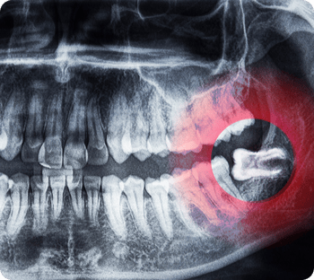A dental x-ray showing and impacted wisdom tooth.