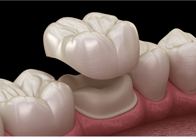 3D illustration of a dental crown, highlighting its shape and placement on a tooth.