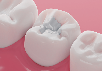 3D illustration of a dental filling placed in a molar, showing how a cavity is restored after tooth decay.
