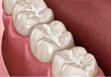 3D illustration showing how fissure sealants protect teeth by filling the grooves and cracks in molars to prevent decay.