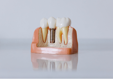 Close-up of a dental model showing a single tooth implant between two natural teeth, illustrating how the implant integrates with the jawbone to replace a missing tooth.