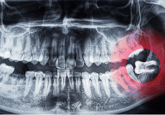 A dental X-ray showing a wisdom tooth growing sideways, pressing against the adjacent molar. The surrounding teeth and jawbone structure are clearly visible, illustrating the potential for impaction and crowding.