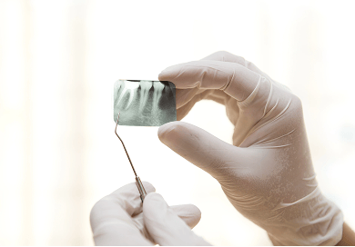 Gloved hands holding a small dental X-ray film showing tooth roots, with a dental tool pointing at the image.