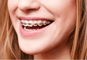 Close up of a big smile with braces.