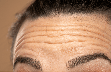 Close-up of some forehead wrinkles.