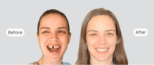 Before-and-after images of a Mulgrave Dental Group patient’s smile transformation. The 'before' photo shows a missing front tooth, while the 'after' photo reveals a beautifully restored, natural-looking smile following dental treatment.