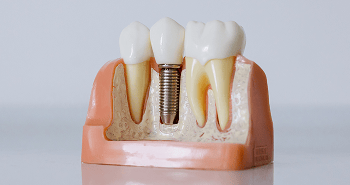 Close-up of a dental model showing a single tooth implant between two natural teeth, illustrating how the implant integrates with the jawbone to replace a missing tooth.