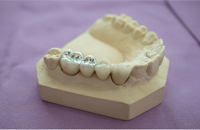 Close up of silver amalgam fillings on a dental tooth model.