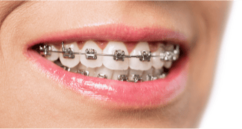Close up of a smile with metal braces.