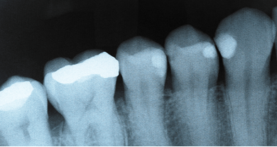 Close-up of a basic dental X-ray showing a detailed section of the lower teeth, highlighting individual tooth structure.