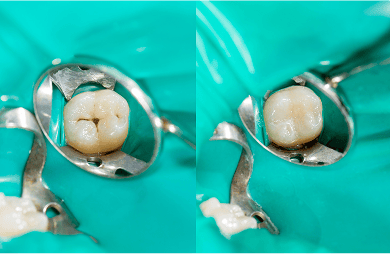 Close up before and after image of a composite filling.