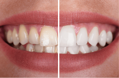 Close-up of a smile showing a before-and-after comparison of teeth whitening, with the left side displaying yellowish teeth and the right side showing visibly whiter, brighter teeth.