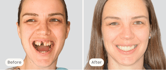 Before-and-after images of a Mulgrave Dental Group patient’s smile transformation. The 'before' photo shows a missing front tooth, while the 'after' photo reveals a beautifully restored, natural-looking smile following dental treatment.