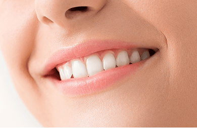 Close up of a woman’s smile after laser gum contouring, showing an even gum line and well-proportioned teeth.