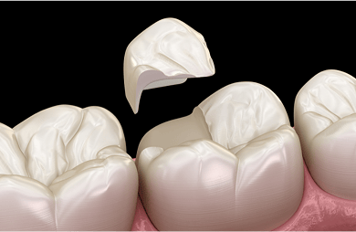 3D illustration of a ceramic fillings.