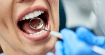 Image of lingual braces, a highly discreet orthodontics option.