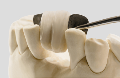Close up of a tooth model showcasing Maryland dental bridges.