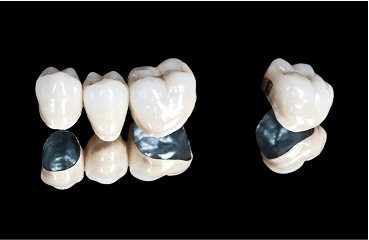 Close up of porcelain-fused-to-metal dental crowns.