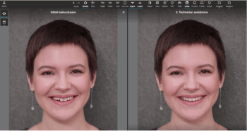 Screen showing Invisalign's ClinCheck 3D software showing a preview of a patient's future smile.