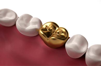 3D illlustration of a gold filling.