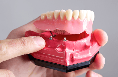 Close up of tooth model showing how implant-supported dentures work.