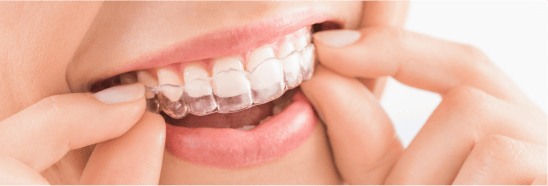 Close-up of a woman putting on an Invisalign clear aligner.