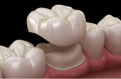3D illustration of a dental crown, highlighting its shape and placement on a tooth.