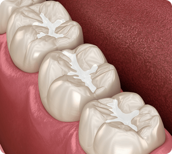 Illustration showing fissure sealants applied on the back teeth.