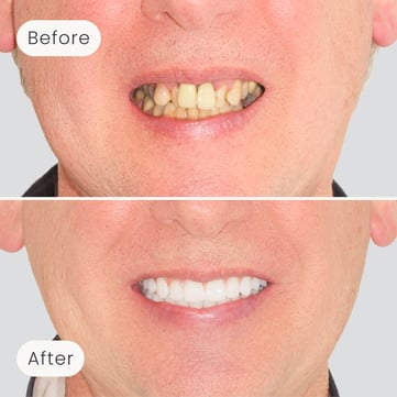 Mulgrave Dental Group patient before All-On-4 treatment, with crooked and discoloured teeth, and after All-On-4 treatment, showing a fully aligned and whiter smile.