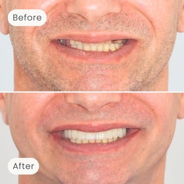 Mulgrave Dental Group patient before All-On-4 treatment, with missing teeth, and after All-On-4 treatment with a fully complete smile.