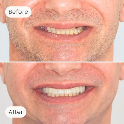 Before and after image of smile transformation after All-on-4 dental implant treatment by Mulgrave Dental Group.
