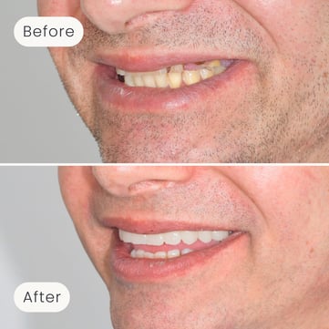 Left side profile of a Mulgrave Dental Group patient before All-On-4 treatment, with missing teeth, and after All-On-4 treatment with a fully complete smile.
