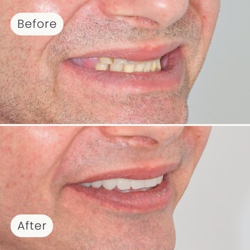 Right side profile of a Mulgrave Dental Group patient before All-On-4 treatment, with missing teeth, and after All-On-4 treatment with a fully complete smile.