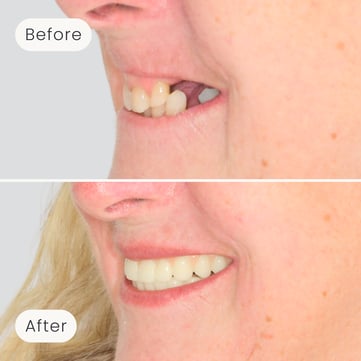 Left side profile of a Mulgrave Dental Group patient before All-On-4 treatment, with many missing teeth, and after All-On-4 implants with a complete set of beautiful, natural looking teeth.