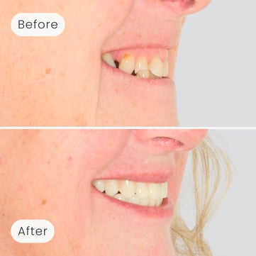 Right side profile of a Mulgrave Dental Group patient before All-On-4 treatment, with many missing teeth, and after All-On-4 implants with a complete set of beautiful, natural looking teeth.