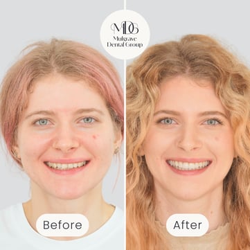 Mulgrave Dental Group patient smiling, showing teeth before and after Invisalign and veneers treatment, with noticeable whitening and alignment improvement.