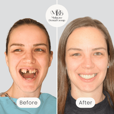 Before and after image of beautiful smile restored with a single tooth implant by Mulgrave Dental Group.