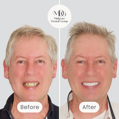 Before and after image of smile transformation after All-on-4 dental implant treatment by Mulgrave Dental Group.
