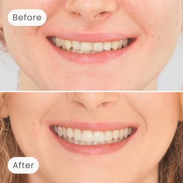 Close-up of a Mulgrave Dental Group patient's smile showing teeth before and after Invisalign and veneers treatment, with noticeable whitening and alignment improvement.