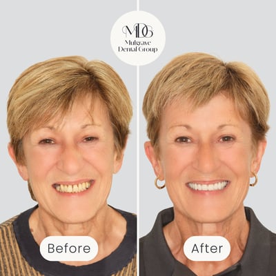 Before and after image of smile transformation after All-on-4 dental implant treatment by Mulgrave Dental Group.