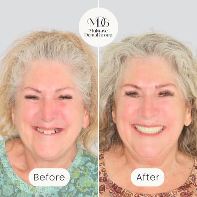 Before and after image of smile transformation after All-on-4 dental implant treatment by Mulgrave Dental Group.