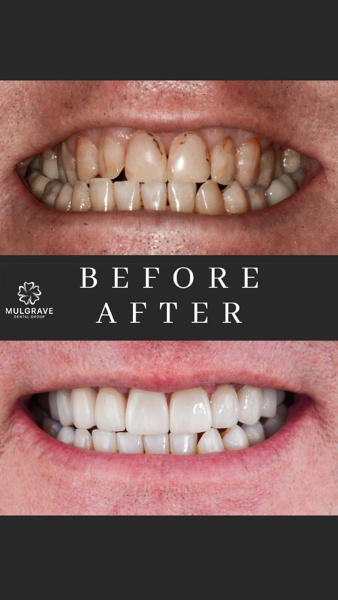 MDG Veneers Before and After BRE001