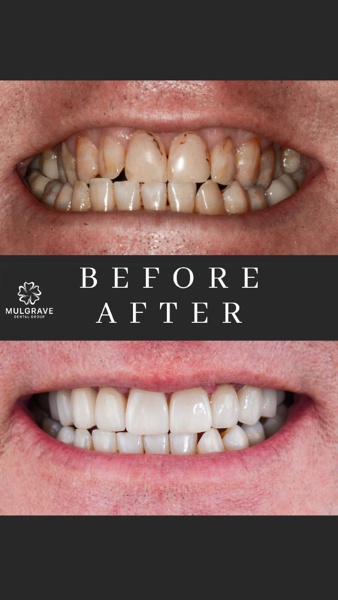 MDG Veneers Before and After BRE001 MDG Veneers Before and After BRE001