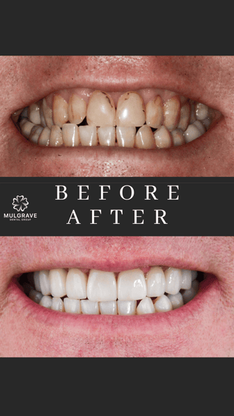 MDG Veneers Before and After BRE001 MDG Veneers Before and After BRE001