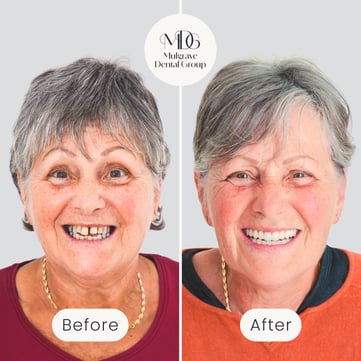 Mulgrave Dental Group patient before All-On-4 treatment, with crooked teeth with large gaps, and after All-On-4 treatment with a flawless, beautiful smile.