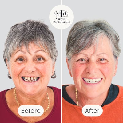 Before and after image of smile transformation after All-on-4 dental implant treatment by Mulgrave Dental Group.