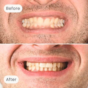 Mulgrave Dental Group patient before orthodontic treatment, with crooked teeth, and after, with a more aligned smile.