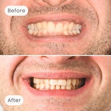 Mulgrave Dental Group patient before orthodontic treatment, with crooked teeth, and after, with a more aligned smile.