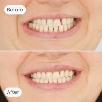 Mulgrave Dental Group patient before orthodontic treatment, with some gaps between the teeth, and after, with no more gaps.